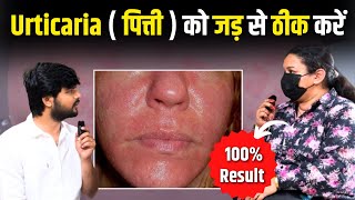 शितपित्त पित्ती का 100 गारंटी से इलाज  Urticaria Treatment  Hives on Skin  Dr Upasana Vohra [upl. by Lederer]