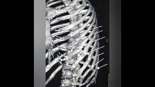 INTERCOSTAL DRAINAGE FOR HEMOTHORAX [upl. by Stephana]