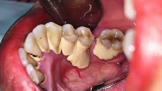 Dental Cleaning To Remove Heavy Tartar  Dentist  Dokter Gigi Tri Putra [upl. by Zeba886]