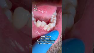 Deep Bite Crowding Braces Invisalign [upl. by Lahcsap369]