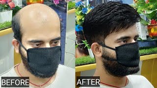 Hair patch clipping tapping bonding fixing hair replacement in Delhi by anas sheikh9650914665 [upl. by Aramad]