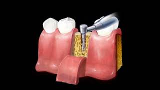 Etape Implant Dentar cu lambou  Bont Protetic  Coroana Dentara [upl. by Nnaitsirhc]