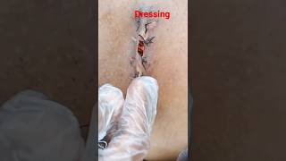 Dressing Of Wound  Dressing  Bandage  Dr Hafeez Aman injury woundhealing bandage patient [upl. by Augustine432]