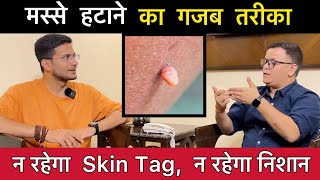 Skin Tags या मस्से हटाने का तरीका  Skin tags removal without surgery  Homeopathy  Himanshu Bhatt [upl. by Nerreg]