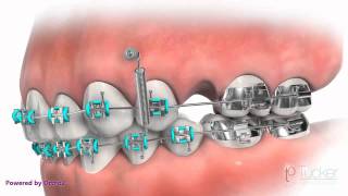 Orthodontic MiniImplant TAD or TSA [upl. by Ysle]