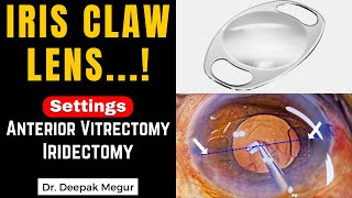 Iris Claw Lens in a case of Lens Induced GlaucomaUsing the Vitrector for IridectomyDr Deepak Megur [upl. by Edialeda200]