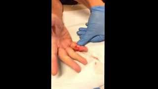 Draining Gout of the Finger [upl. by Letch366]