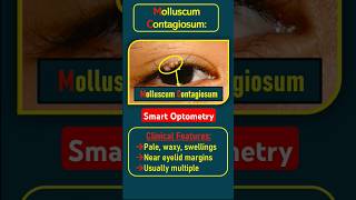 Molluscum Contagiosumoptometrist optometry optometrists eyediseases eyedisorder eyeliddiseases [upl. by Haya]