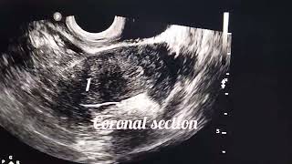 Ultrasound diagnosis of septate uterus [upl. by Nerrag3]