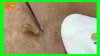 Remoção de cravos nas costas  Tratamento de acne e muito satisfatórioThe Most Satisfying Blackhead [upl. by Onileva]