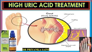 Hyperuricemia  High uric acid level in blood  HOMEOPATHY TREATMENT drpriyankashomeopathy [upl. by Nnateragram]