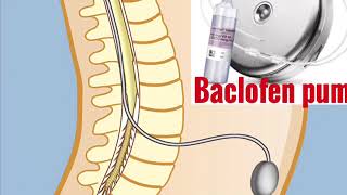 Baclofen pump for paralytic patients [upl. by Dre357]