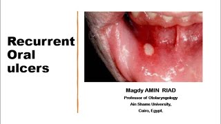 II Recurrent Oral Ulcers [upl. by Tymon]