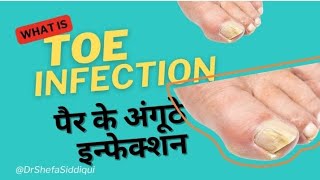 How a Toe Nail Infection Can Ruin Your Life  पैर के अंगूठे में इन्फेक्शन का इलाज [upl. by Quita336]