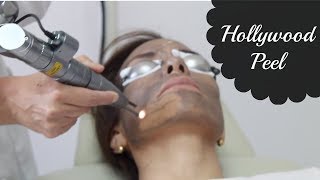 Laser Peel Hollywood Inovador tratamiento para manchas [upl. by Massarelli]