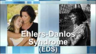 What Is EhlersDanlos Syndrome [upl. by Euginomod]