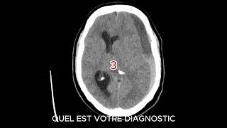 HEMATOME SOUS DURAL CHRONIQUE radiologystudent hospitalityeducation [upl. by Latterll]