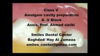 Amalgam Class V cavity preparation  Dr Ahmed Sleibi Smiles center [upl. by Hendren32]