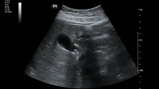 Episodes of EpigastricRUQ Abdominal Pain in 17 yo Female [upl. by Ybanrab]