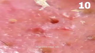 Nose Blackhead Removal Whiteheads Wide Spread Clip 10 [upl. by Alpheus]