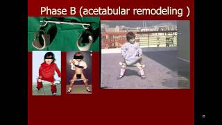 Educational video for the treatment of developmental dysplasia of hip without surgery [upl. by Jerald]