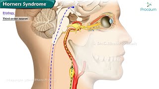 Horners Syndrome  Etiology  Classification  Diagnosis  Treatment [upl. by Nicolai]