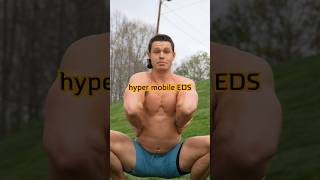 Hypermobile EDS whealth stayflexy [upl. by Syned]