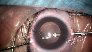 Pars plicata lensectomy for congenital cataract in a 3 months old child [upl. by Adnolor927]