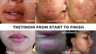 TRETINOIN BEFORE AND AFTER  FULL TRETINOIN EXPERIENCE my journey from start to end Adult Acne [upl. by Deonne]