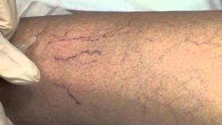 Spider Vein Sclerotherapy [upl. by Zuckerman]