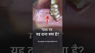 थूक की ग्रंथि का मुँह में निकास  Parotid opening in mouth  Stensons duct [upl. by Romaine]