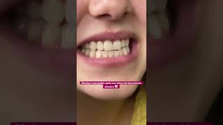 blanchiment blanchimentdentaire dents sourire maroc viralshort vital [upl. by Ahsirek]