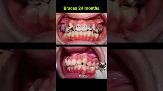 Braces correct All case of crooked teeth braces orthodontist bracesbraket [upl. by Nueoras]