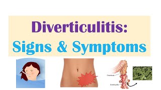 Diverticulitis Signs amp Symptoms And Why They Occur [upl. by Constantia473]