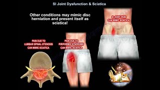 SI Joint Dysfunction amp Sciatica  which one is causing the pain  how do we treat it [upl. by Hendrix]