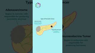 Types of Pancreatic Cancer Explained  Knowing the Different Forms  Dr Vivek Sukumar [upl. by Ji]