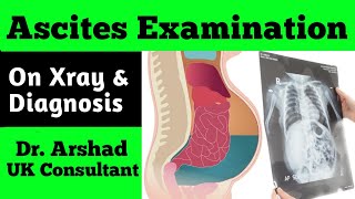 Ascites Examination on Xray and Differential Diagnosis [upl. by Virgilia239]