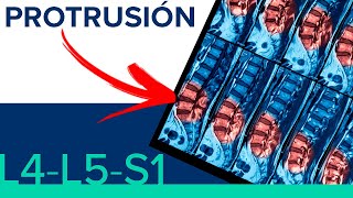 PROTRUSION L4L5 y L5S1 😤 ¿Hernia de disco o protrusion discal [upl. by Urson483]