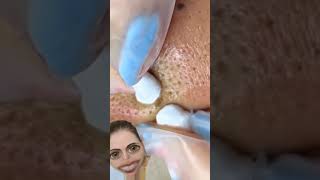 Blackheads Removal  Acne Treatment and Very Satisfying Satisfying Pimple pop blackheads [upl. by Nohtanoj]