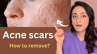 How to reduce Acne Scar  Chemical peels Dermaroller Lasers  Cost  Dermatologist Dr Aanchal [upl. by Tana]