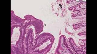 Histopathology ColonTubular adenoma [upl. by Enitsugua]