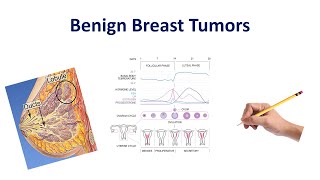 Benign Breast Conditions  USMLE COMLEX NCLEX [upl. by Uahsoj]