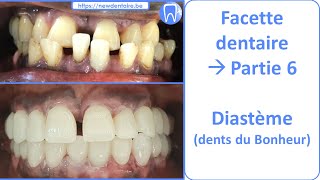 Facette dentaire et dents du bonheur Diasteme  Guide complet  partie 6 [upl. by Coltun981]