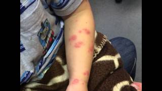 erythema multiforme caused by epilepsy med lamictal watch it progress [upl. by Anaeerb460]