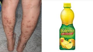 Home Remedies Series  Get Rid of Dark Spots On Legs amp Body With Lemon Juice [upl. by Eamanna333]