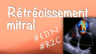 Rétrécissement mitral  Valvulopathies cardiaques item N°233 [upl. by Hestia]