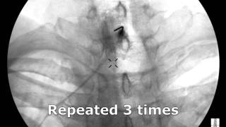 Cervical Interlaminar Epidural Steroid Injection  ThePainSourcecom [upl. by Niawd]