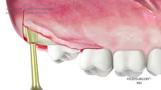 PIEZOSURGERY  Dr Fabrizio Fontanella  Upper tooth extraction [upl. by Aira475]