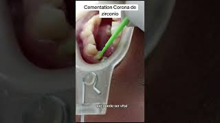 protocolo de cementación de una corona de zirconio [upl. by Soluk]