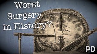 The Dark side of Science The Lobotomy the worst surgery in history Documentary [upl. by Pedersen362]